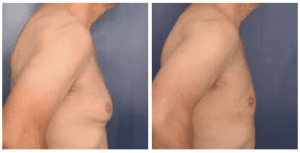 Before and after image of older male after having gynecomastia surgery.